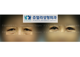 Upper/Lower Blepharoplasty