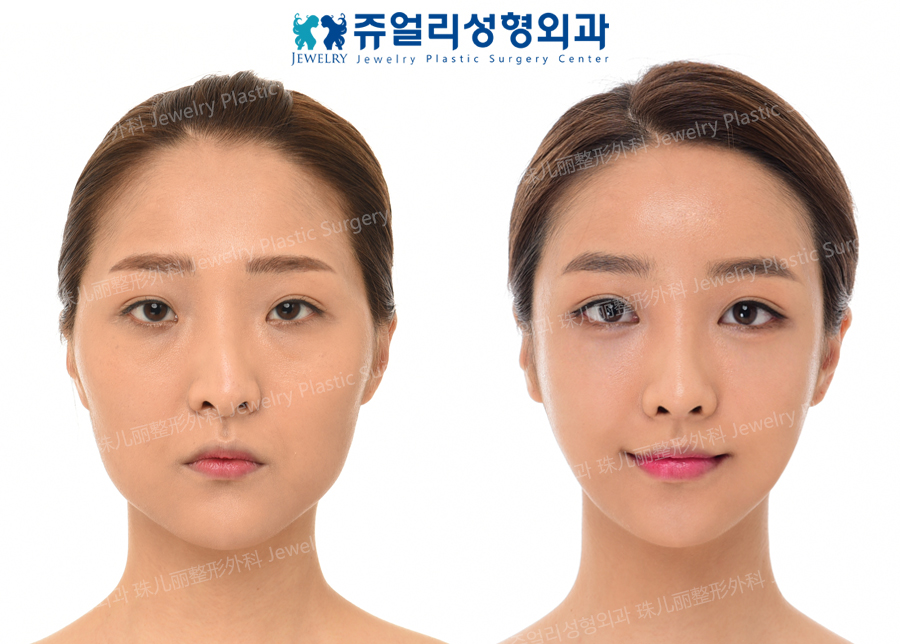 Eyes Surgery+Fat-Repositioning Transconjunctival Blepharoplasty+Downturned Nose Correction+Cube Fat Grafting+Facial Contouring Surgery