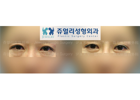 Upper/Lower Blepharoplasty