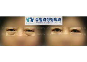 Upper/Lower Blepharoplasty