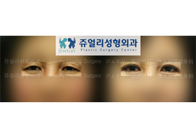 Upper/Lower Blepharoplasty