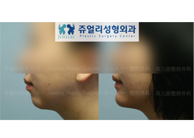 Chin Implant