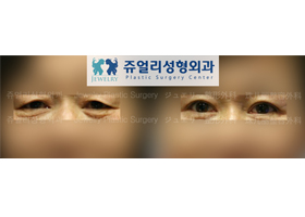 Upper/Lower Blepharoplasty