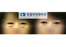 Upper/Lower Blepharoplasty