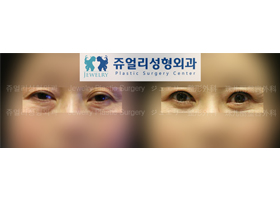 Upper/Lower Blepharoplasty