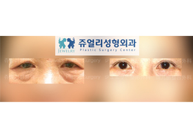 Upper/Lower Blepharoplasty