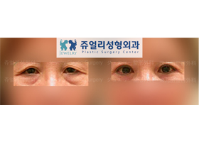 Upper/Lower Blepharoplasty