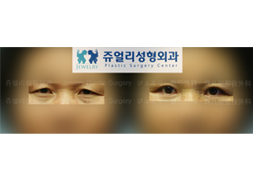 Upper/Lower Blepharoplasty