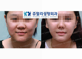 Cheek Liposuction + Chin Botox