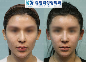 Cheekbone Reduction + Square Jaw Reduction + Chin Lifting