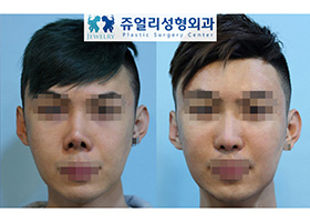 Nose Reoperation - Rib Cartilage