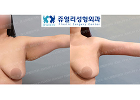 Arm Liposuction (+Skin Excision)