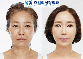 Lower Blepharoplasty, Brows Lifting, Face Lifting, Fat Grafting, Nose Reoperation, Parasanal Reoperation