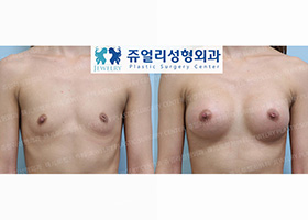 Breast Augmentation + Sunk Nipple Surgery