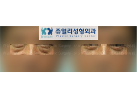 Men (Lower Blepharoplasty)