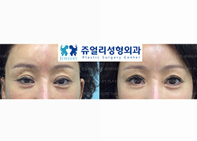 Double Eyelids Reoperation - Ptosis Correction