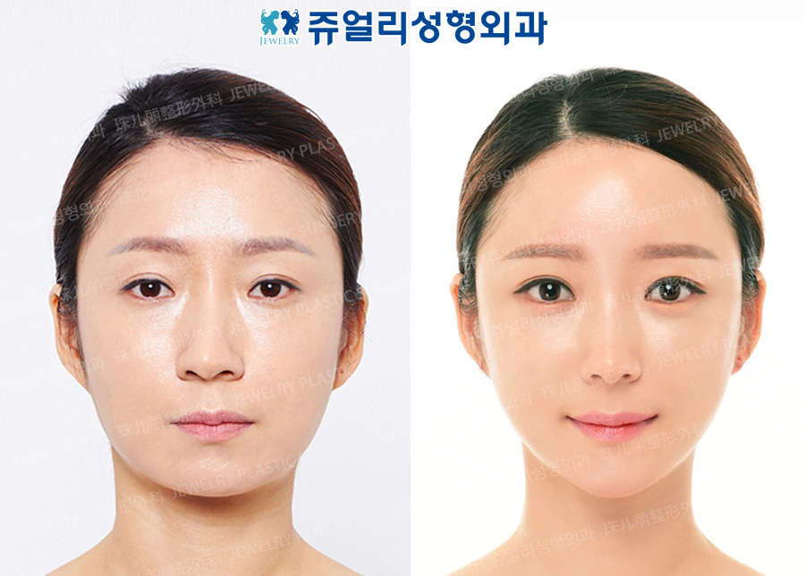 Eyes Surgery+Loveband+Nose Surgery+Cube Fat Grafting+Double Chin Liposuction
