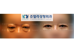 Upper/Lower Blepharoplasty