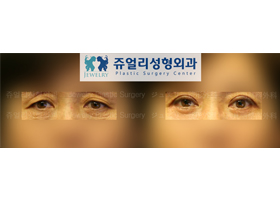 Upper/Lower Blepharoplasty