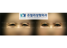 Upper/Lower Blepharoplasty