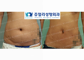 Abdomen, Flank, Lower Back Liposuction
