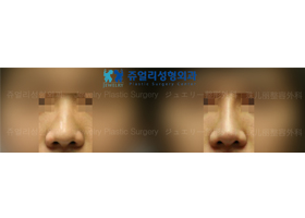 Nose Surgery