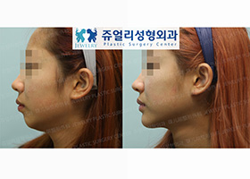 Short Chin Implant + Double Chin Liposuction