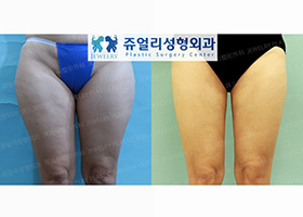 Thigh Liposuction