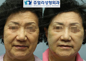 Upper/Lower Blepharoplasty