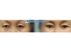 Upper/Lower Blepharoplasty