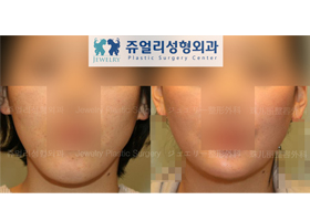 Chin Length Reduction (Long Chin Surgery)