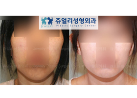 Chin Length Reduction (Long Chin Surgery)