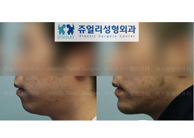 (Men) Chin Advancement Surgery