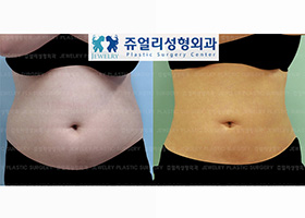 Abdomen, Flank, Lower Back Liposuction