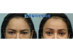 Forehead Lifting + Lower Blepharoplasty