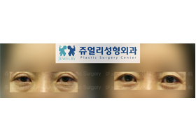 Upper + Lower Blepharoplasty