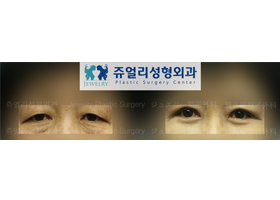 Upper+ Lower Blepharoplasty