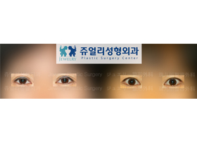 Ptosis Reoperation