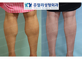 Calf Size Reduction High-Frequency (Nerve Block)