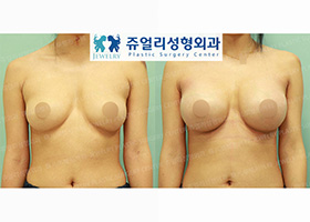 Breast Augmentation