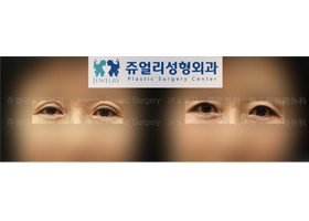 Upper Blepharoplasty (Reoperation)