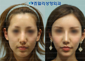 Cheekbone + Square Jaw + Chin Reduction