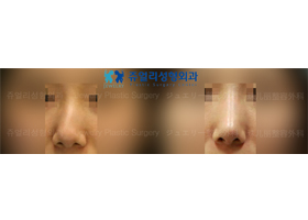 Nose Surgery - Bent Nose (Osteotomy)