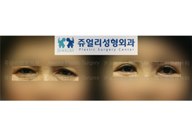 Upper/Lower Blepharoplasty