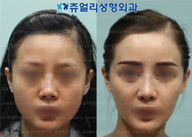 Square Jaw Reduction