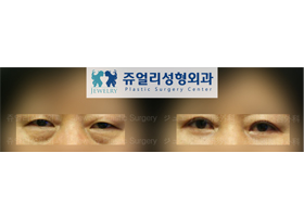 Upper+ Lower Blepharoplasty