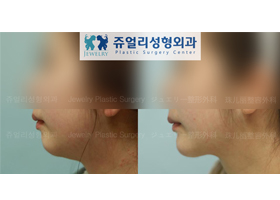 Chin Implant