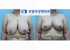 Breast Size Reduction + Lifting