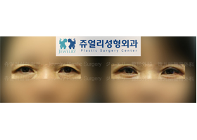 Upper/Lower Blepharoplasty