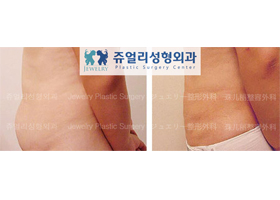 Abdomen Liposuction